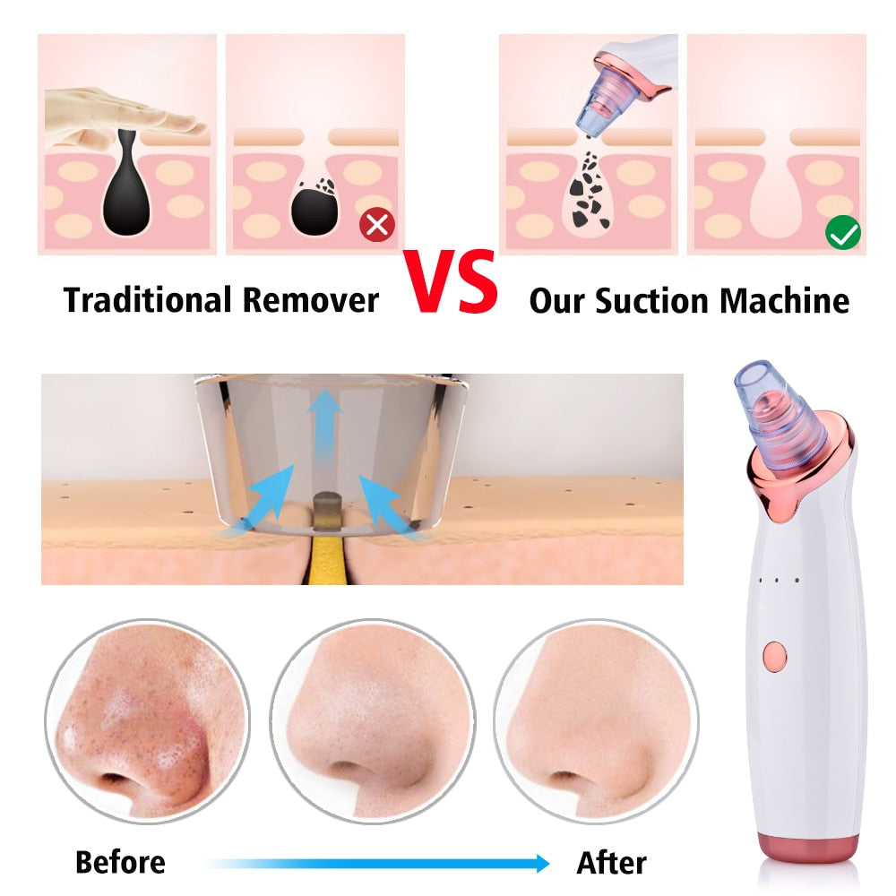 Blackhead Pro Suction